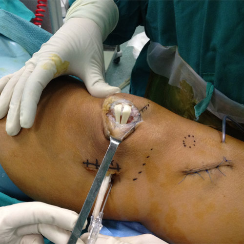 Reconstrucción ligamento PFM cirugia femoropatelar 01