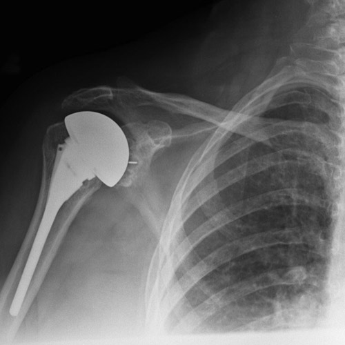 artrosis hombro cirugia hombro clinica darder 01
