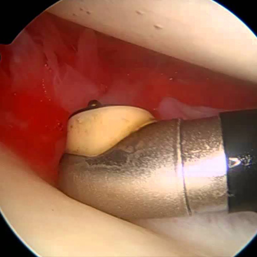 capsulitis adhesiva cirugia hombro clinica darder