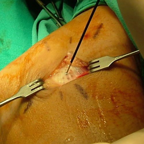 epicondilitis cirugía codo clínica darder