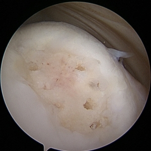 tratamiento lesion cartilago condral microfractura