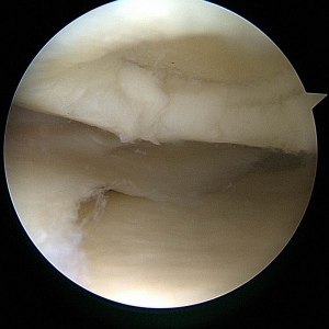 tratamiento lesion cartilago osteocondral rodilla 01