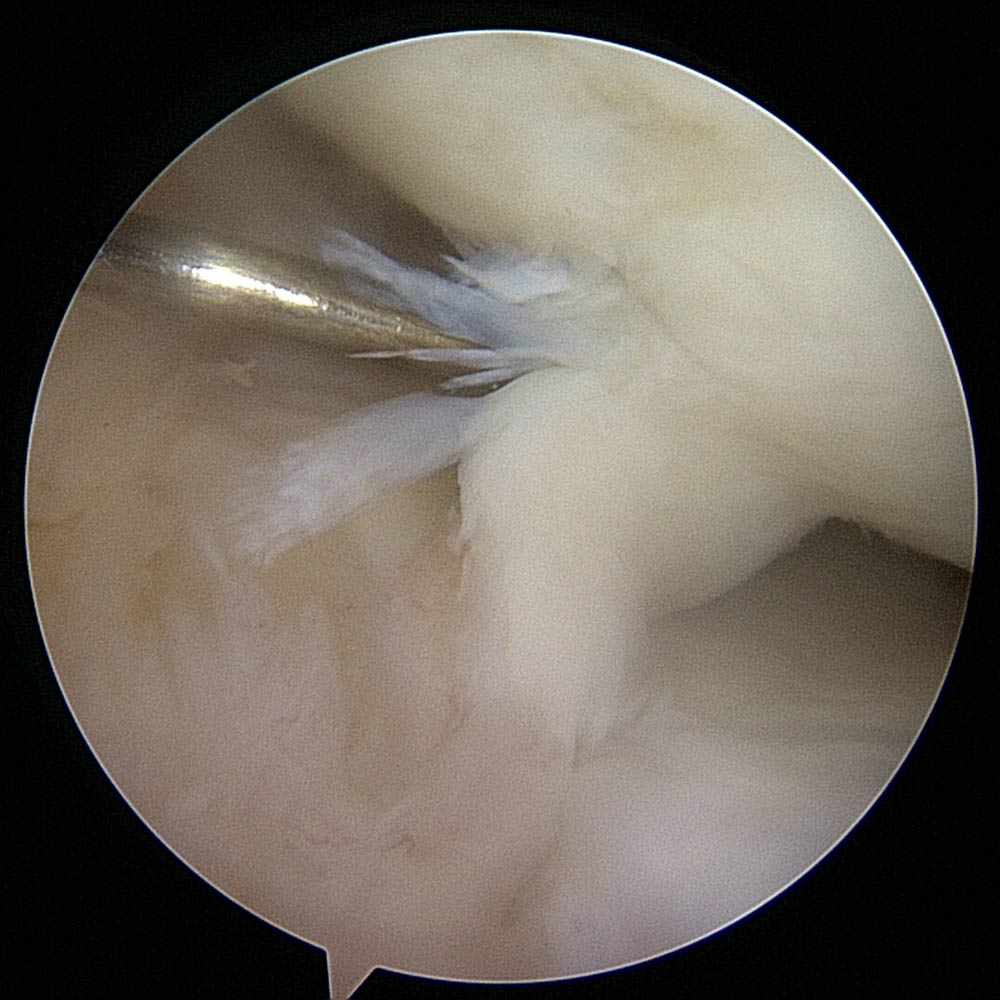 Cartilago-Lesion-osteocondral-rodilla
