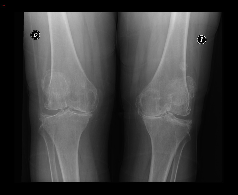 Image: Radiografía de rodilla en la artrosis - Manual MSD versión para  profesionales