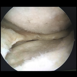 artrosis-femoropatelar-lesion-rodilla