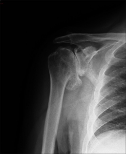 artrosis glenohumeral lesión hombro