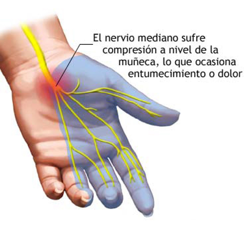 Cirugía muñeca Clinica Darder Traumatología Valencia