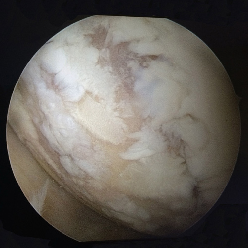 condropatia femoral tratamientos rodilla cirugia clinica darder articulos valencia